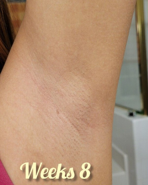 iis S. after treatment