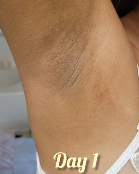 iis S. before treatment
