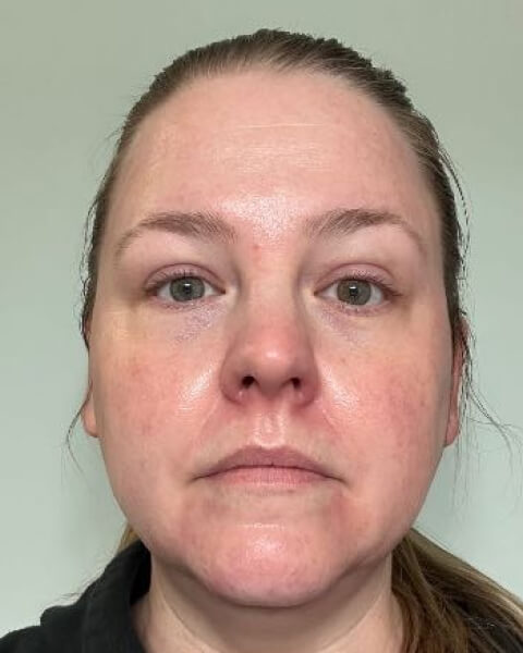 Jamie M. after treatment
