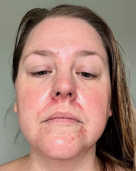 Jamie M. before treatment