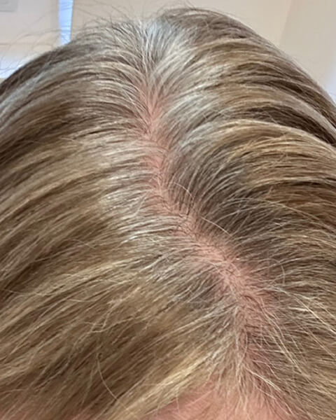 Jen after treatment