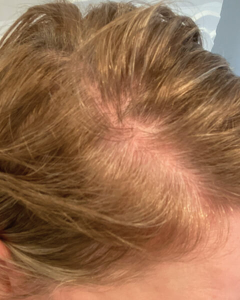 Jen before treatment