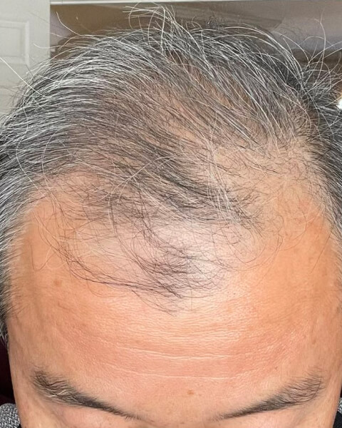 Jinshan L. before treatment