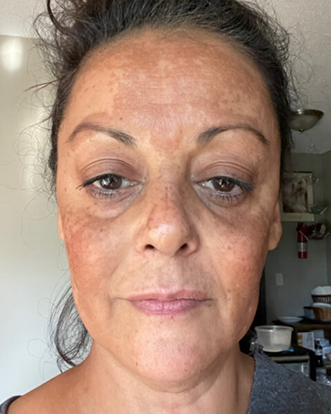 Jodi C. before treatment