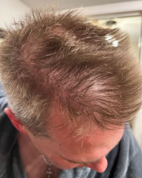 John H. before treatment