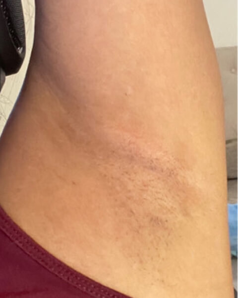 Julie W. after treatment