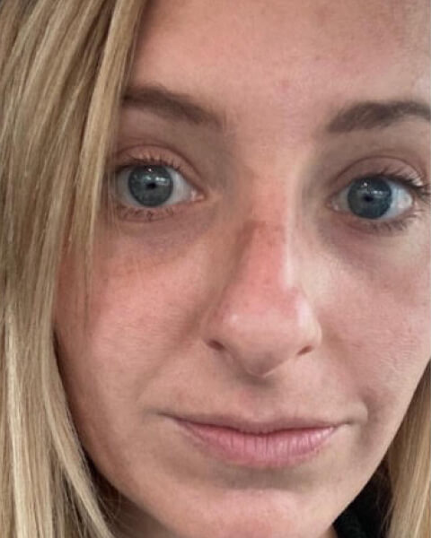 Katie A. before treatment