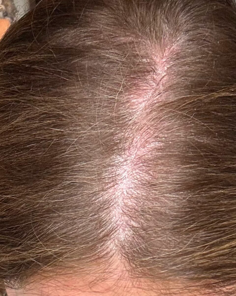 Katja M. after treatment