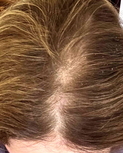 Katja M. before treatment