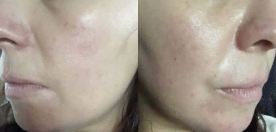 Kayla M. after treatment