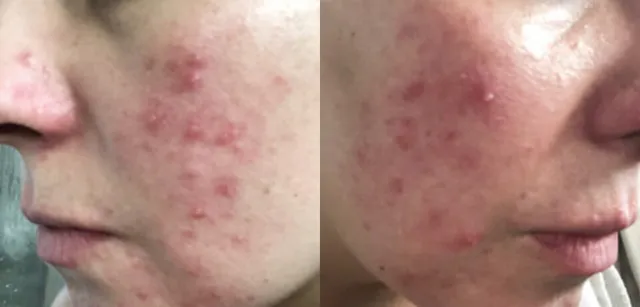 Face cream for redness before and after