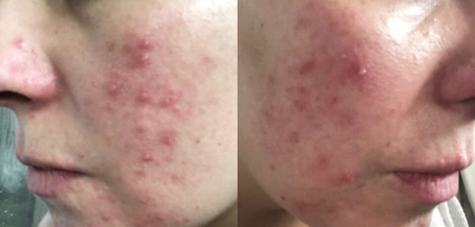 Kayla M. before treatment