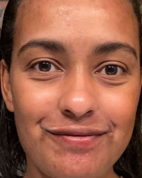 Keara C. after treatment