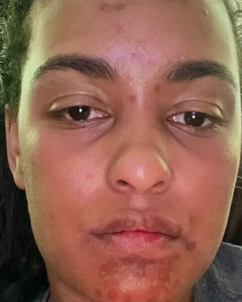 Keara C. before treatment