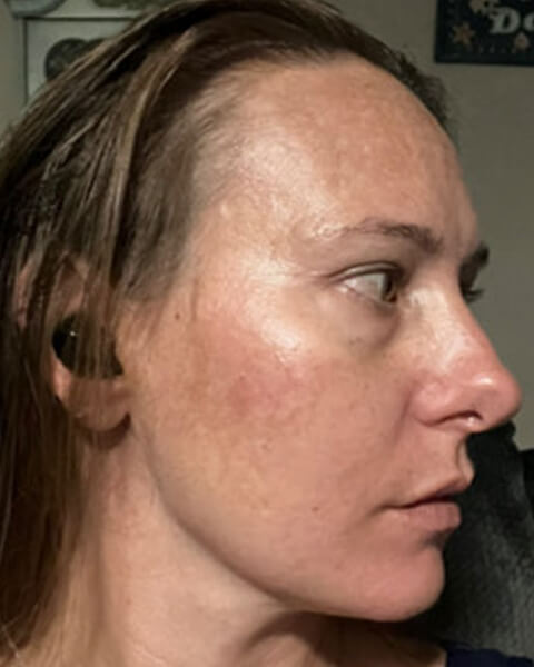 Lacy D. after treatment