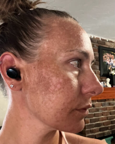 Lacy D. before treatment