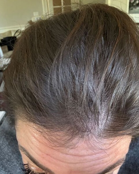 Laura S. after treatment