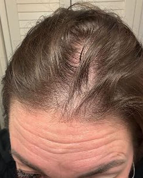 Laura S. before treatment