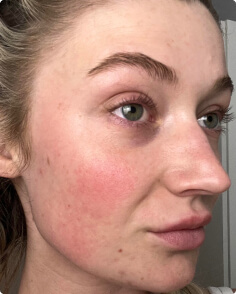 Lauren R. after treatment