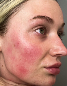 Lauren R. before treatment