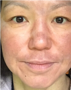 Leeah after treatment