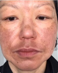 Leeah before treatment