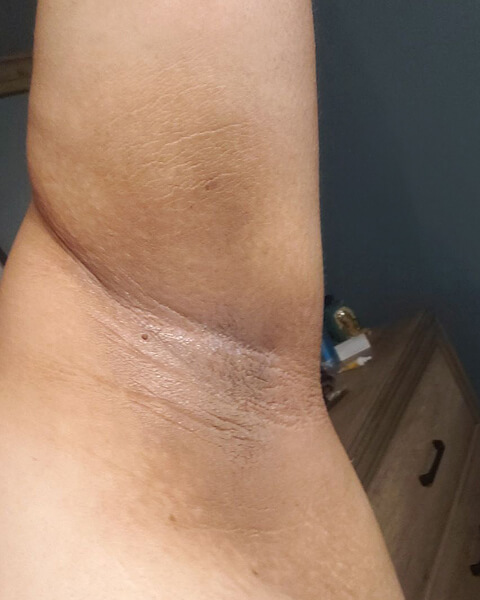 Liliana L. after treatment