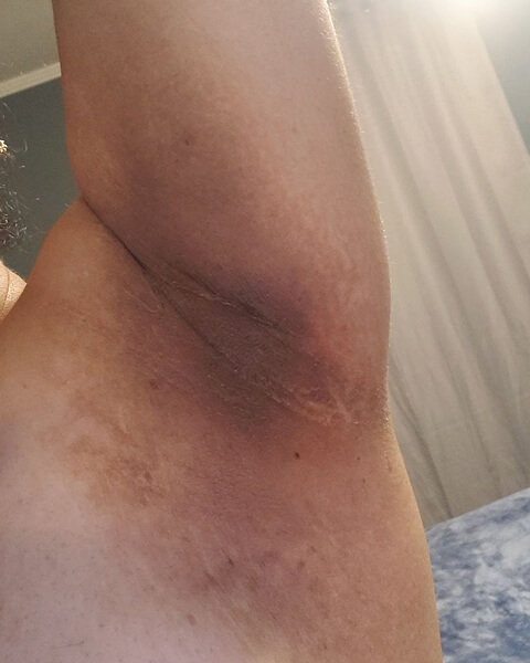 Liliana L. before treatment