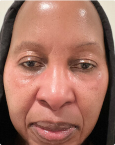 Malena R. after treatment