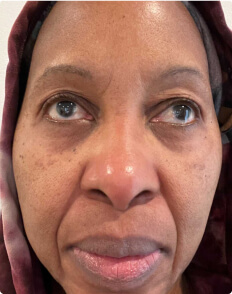 Malena R. before treatment