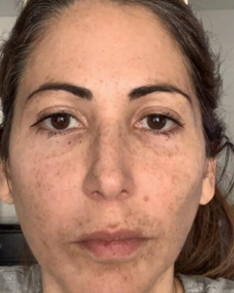 Maria P. before treatment