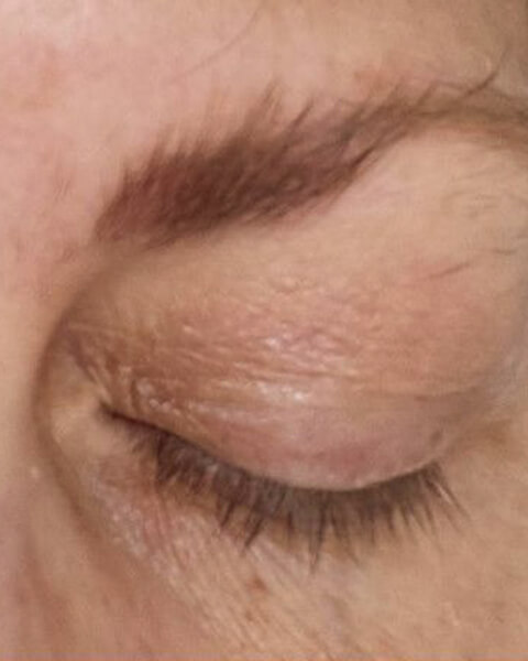 Melissa P. before treatment