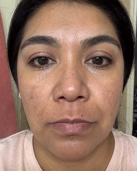 Mirta G. after treatment