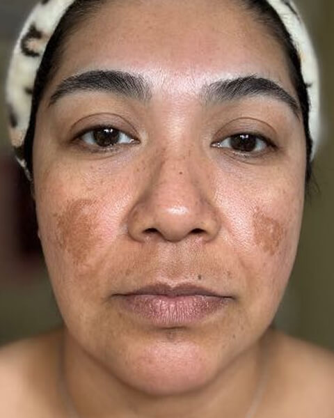 Mirta G. before treatment
