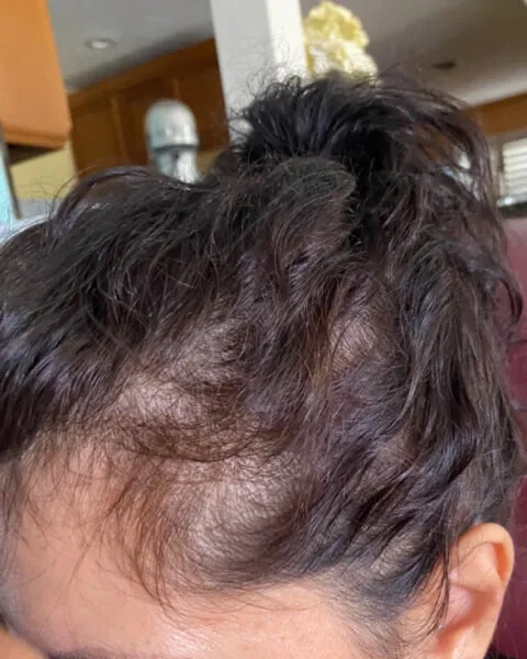 Prescription Hair Loss Solution - Real Results