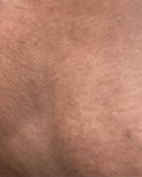 Myasia S. after treatment