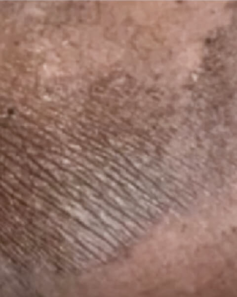 Myasia S. before treatment
