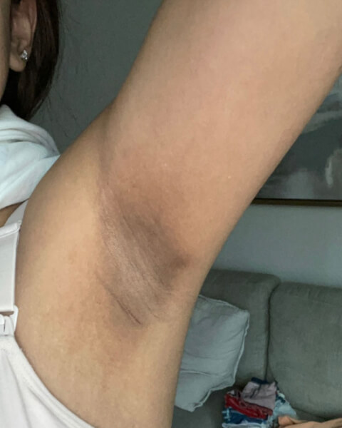 Nancy Z. before treatment