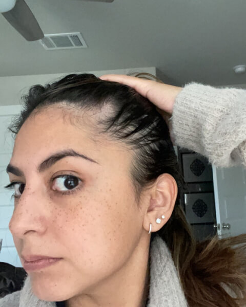 Nancy Z. before treatment