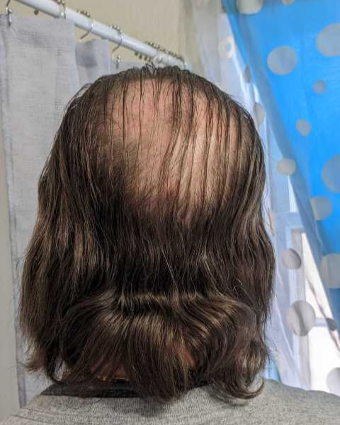 Randall C. before treatment