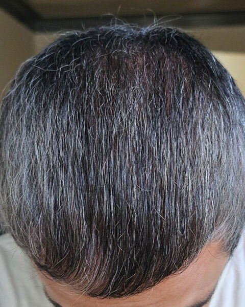 Rd after treatment