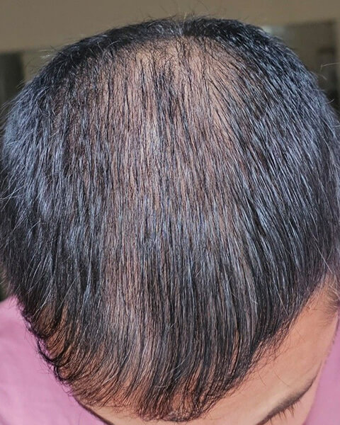 Rd before treatment