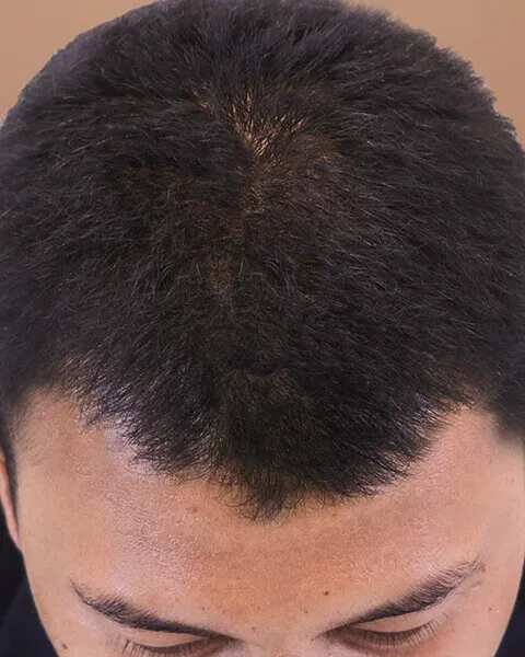 Hair Loss Treatment for Men - Reviews & Transformations