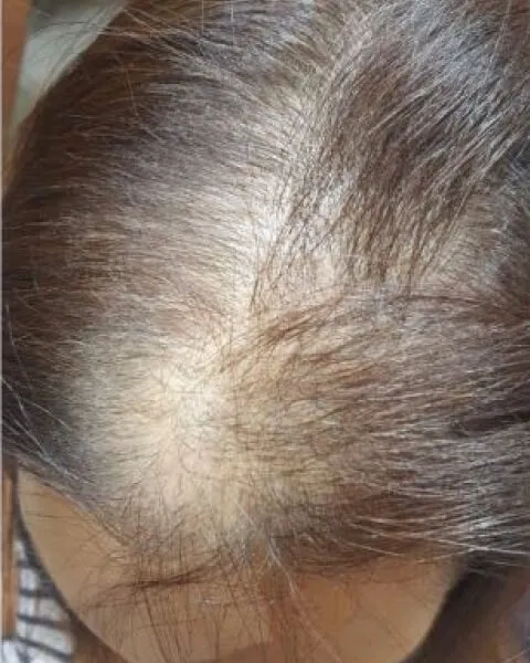 Hair Growth Results - Photos & Testimonials