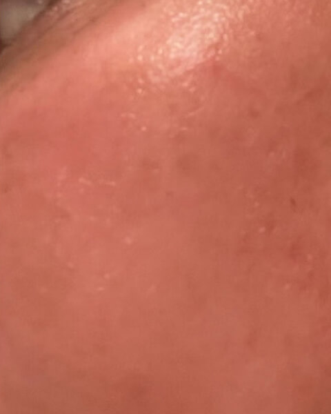 Sharyn B. after treatment