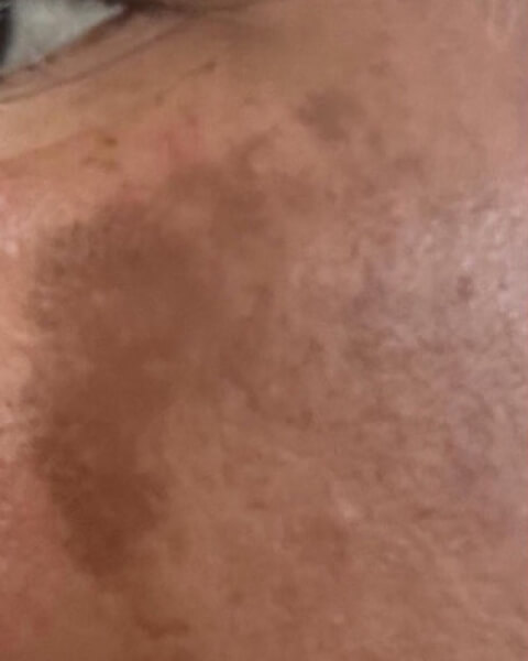 Sharyn B. before treatment