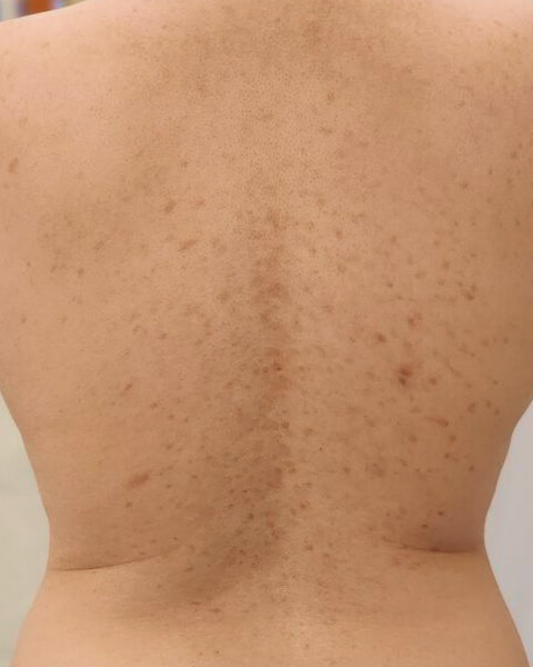 Shirlene K. after treatment