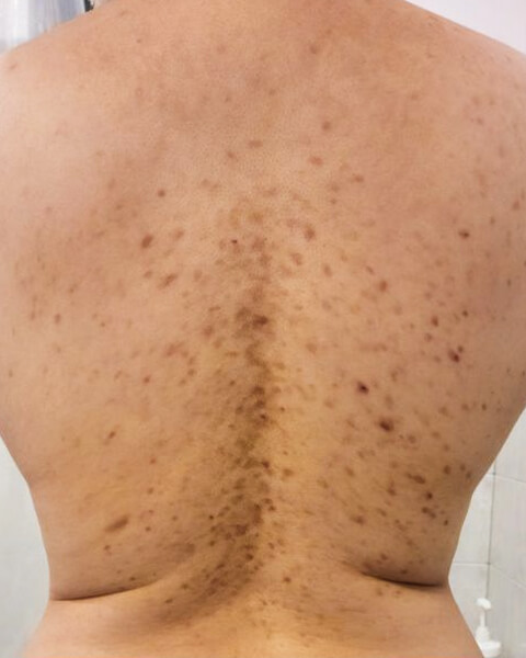 Shirlene K. before treatment