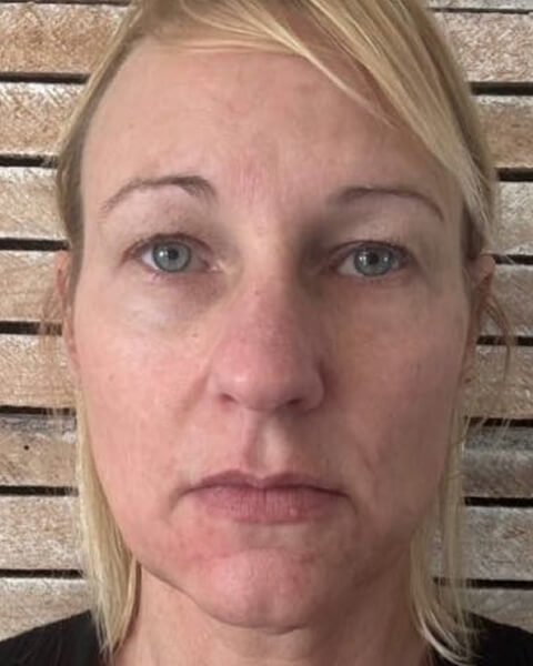 Stacy H. after treatment