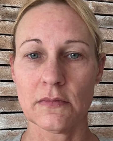 Stacy H. before treatment